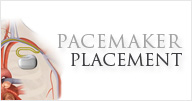 Pacemaker - Norvist